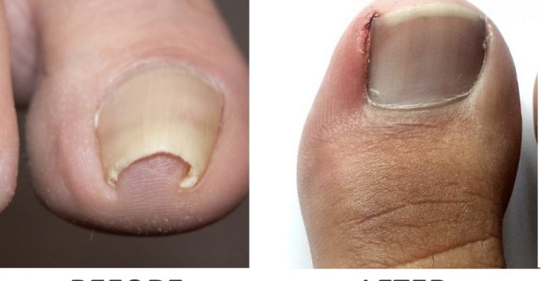 Surgery for ingrown toenails