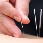 acupuncture6