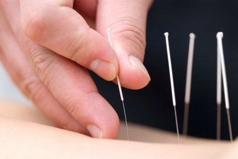 acupuncture6