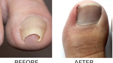 Surgery for ingrown toenails