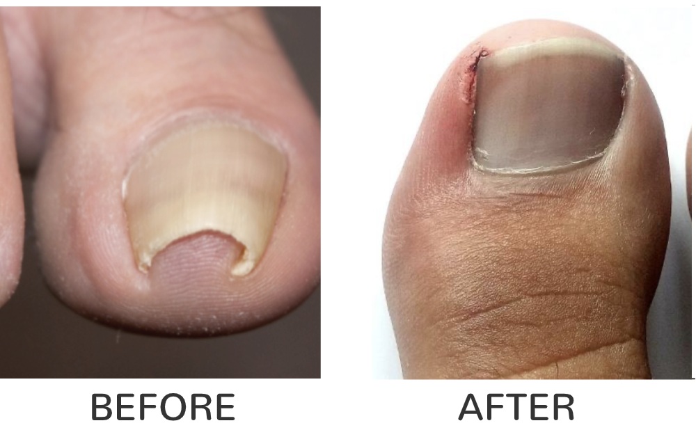 Surgery for ingrown toenails