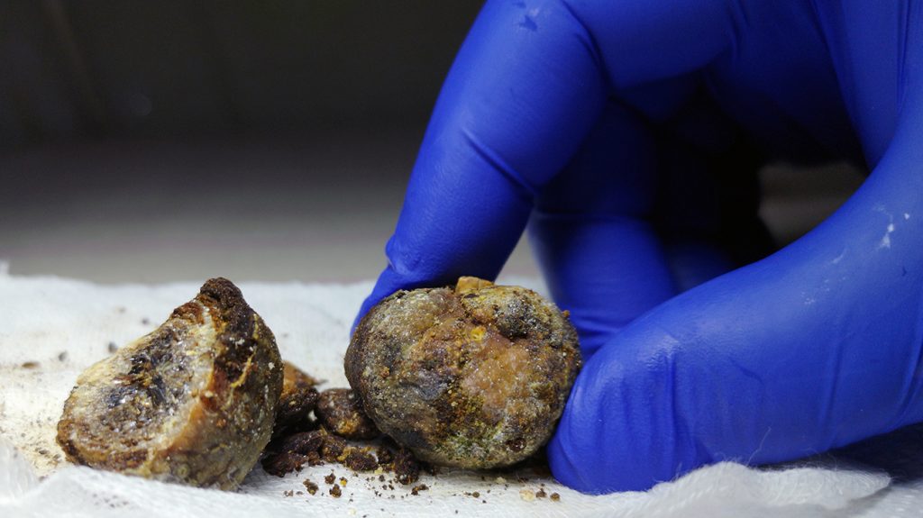 Here Is What You Need To Know About Gallstones Treatment And Symptoms Fit For Happy Life