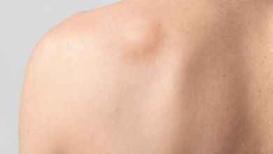 What you must know about Lipoma Removal in Singapore?