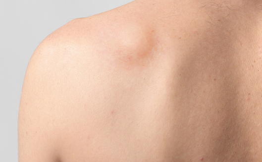 What you must know about Lipoma Removal in Singapore?