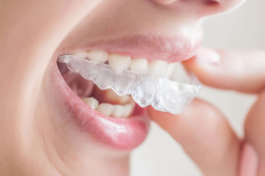 Step 3: Wearing your Aligners