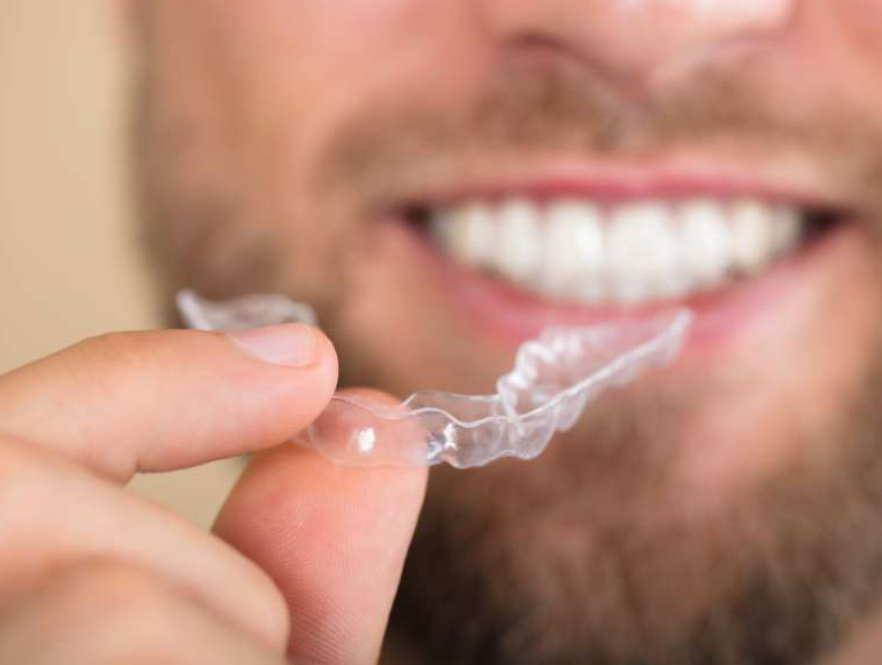 How Invisalign Works: A Step-by-Step Guide to the Clear Aligner System